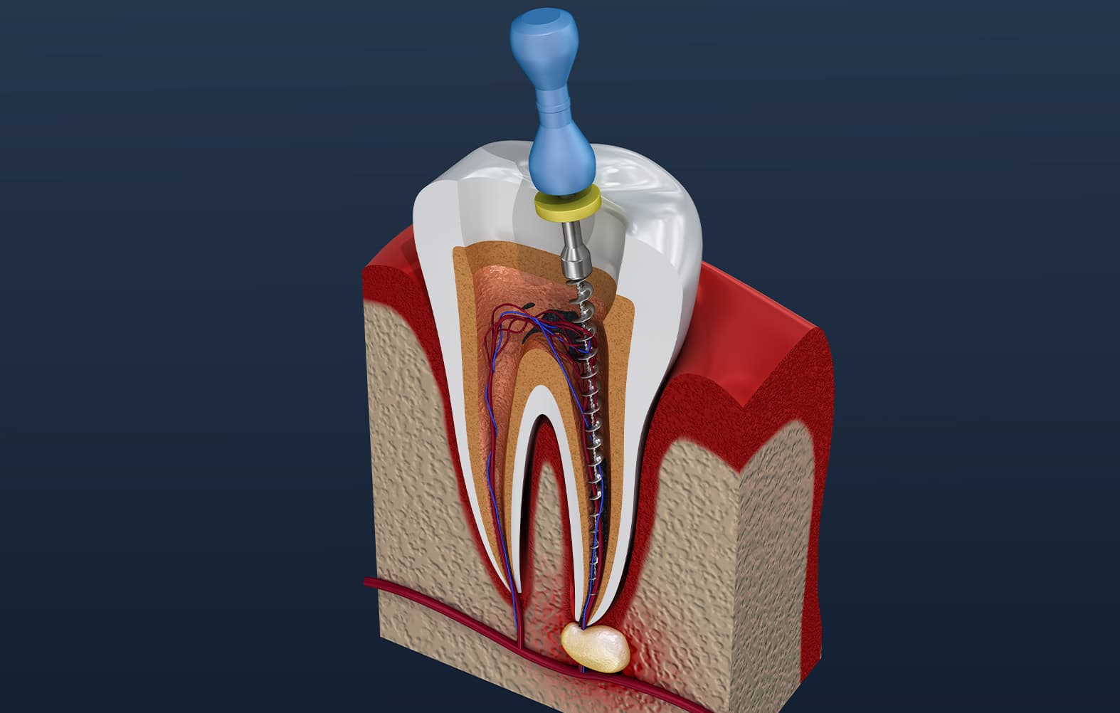 Read more about the article Tratamentul endodontic sau tratamentul de canal