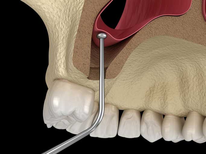 Read more about the article Sinus lift