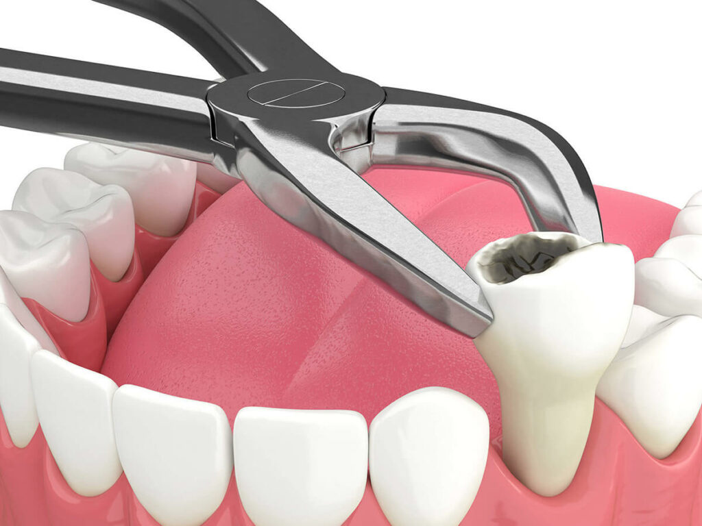 Read more about the article Care sunt indicațiile după o extracție dentară?